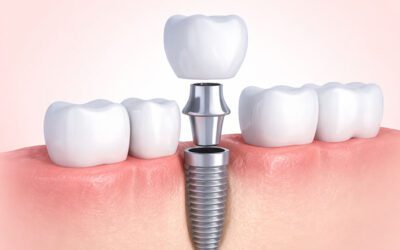 Чи боляче ставити імпланти?