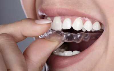 Вирівнювання зубів