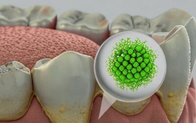 Як видалити наліт на зубах?